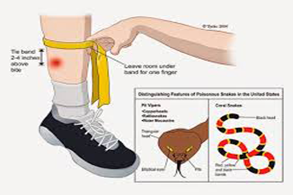 snakebite management