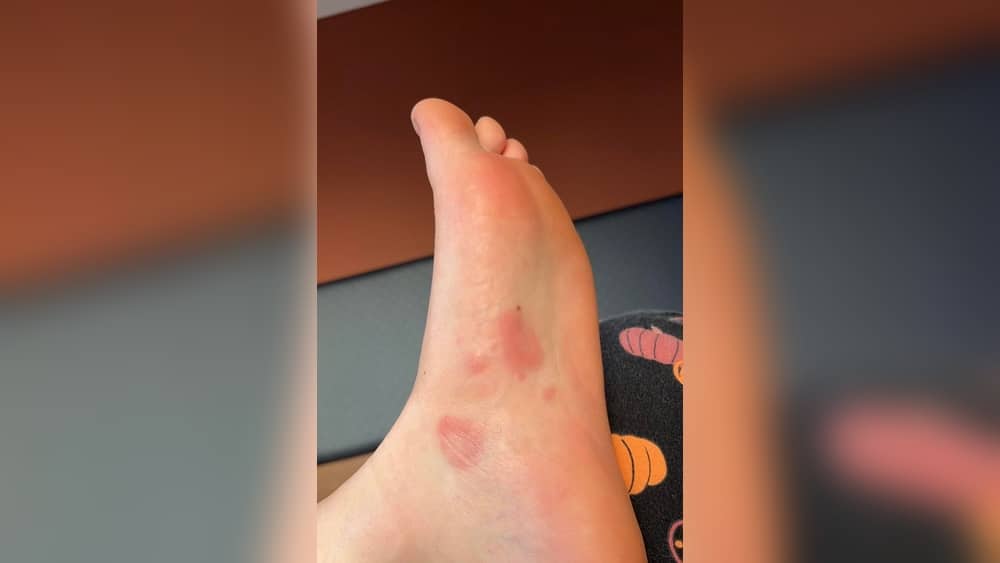গর্ভাবস্থায় ত্বকে র‍্যাশ হলে কী করবেন (Pregnancy Skin Rash)